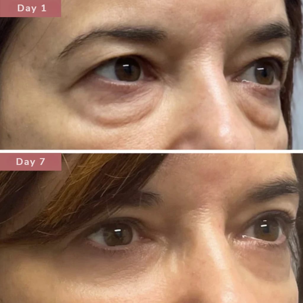 RestedGlow™: Bio-Collagen Eye Patches